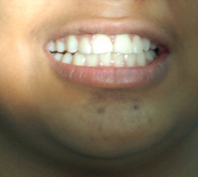 Teen shot of teeth