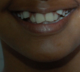 severe teeth misalignment