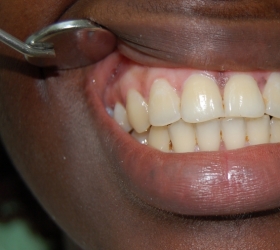 dental implants final result