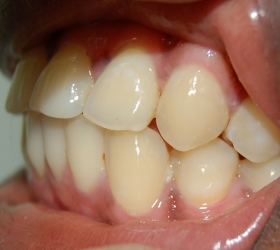 dental implants half way