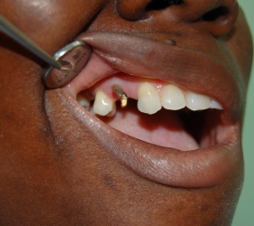 side view of tooth issue