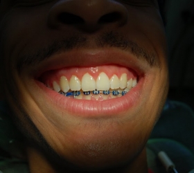 teeth realignment