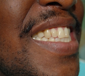 final tooth placement