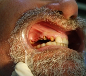 Elderly man with serious dental issue