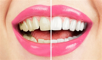teeth-bleaching2