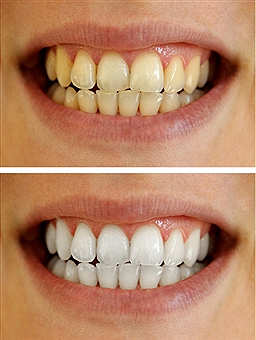 teeth-bleaching3
