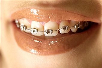 orthodontics-img3